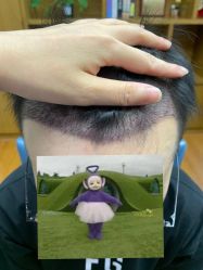 -大麦微针植发全国连锁