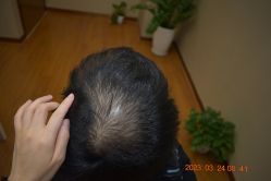 -大麦微针植发全国连锁