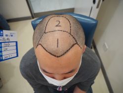 -大麦微针植发丨全国连锁