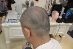 点击看大图 -大麦微针植发丨全国连锁