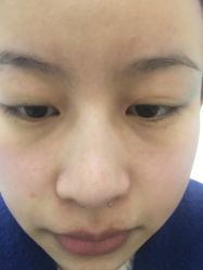-成都苗方清颜专业祛痘