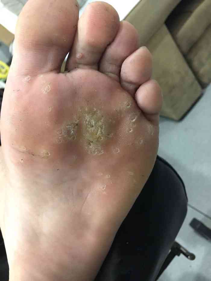 刘一刀修脚-"刘师傅修脚特别认真细致,修脚技术特别好,.