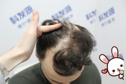 -大麦微针植发丨全国连锁