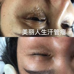 -美丽人生祛斑扁平疣汗管瘤中心