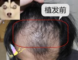 -大麦微针植发全国连锁