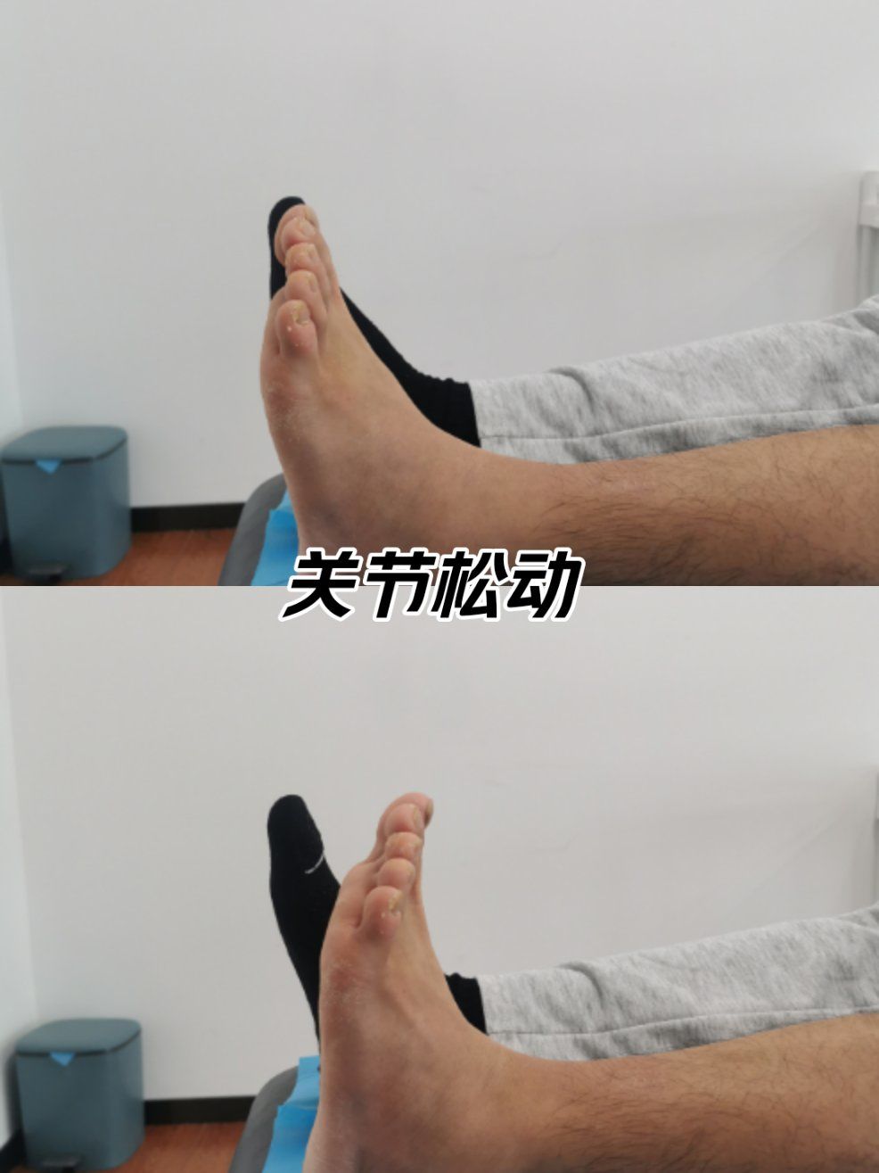 腓骨骨折,踝关节活动受限,踝关节松动效果