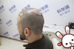 -大麦微针植发丨全国连锁