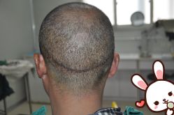 点击看大图 -大麦微针植发丨全国连锁