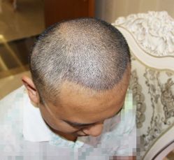 -大麦微针植发丨全国连锁