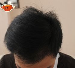 -大麦微针植发丨全国连锁