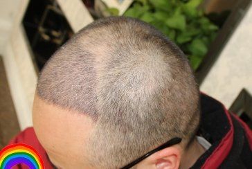 -大麦微针植发丨全国连锁