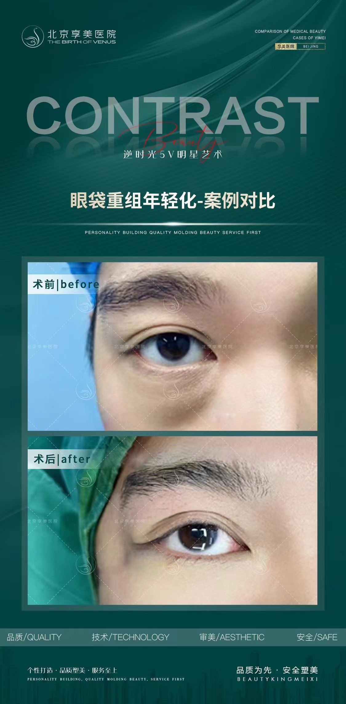 99 眼袋脂肪团膨出,皮肤松弛眼轮匝肌
