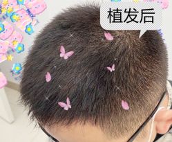 -大麦微针植发全国连锁