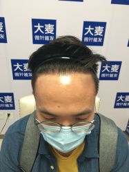 -大麦微针植发丨全国连锁