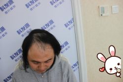 -大麦微针植发丨全国连锁