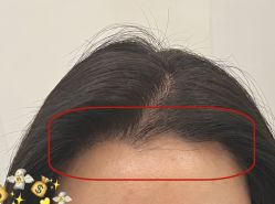 -大麦微针植发全国连锁