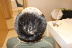 -大麦微针植发丨全国连锁