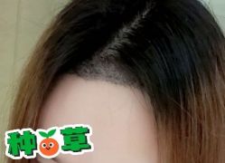 -大麦微针植发丨全国连锁