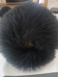 -大麦微针植发丨全国连锁