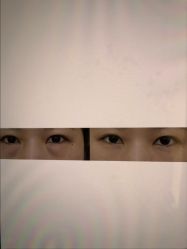 -广州健丽·去眼袋医疗美容机构