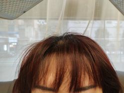 -碧莲盛·不剃发植发