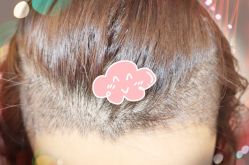 -大麦微针植发全国连锁