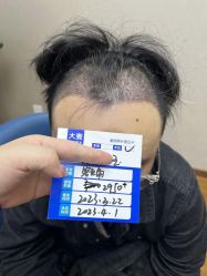 体验后-大麦微针植发全国连锁