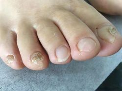 -德哥灰指甲脚气甲沟炎跖疣护理