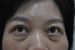 点击看大图 体验前-广州健丽·去眼袋医疗美容机构