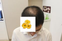 -大麦微针植发丨全国连锁