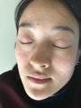 -美丽人生祛斑扁平疣汗管瘤中心