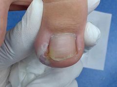 -Andrew指甲专科灰指甲·甲沟炎矫正·3D步态矫形鞋垫定制(上海法华镇路旗舰店)