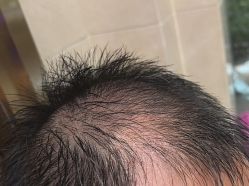 -碧莲盛·不剃发植发