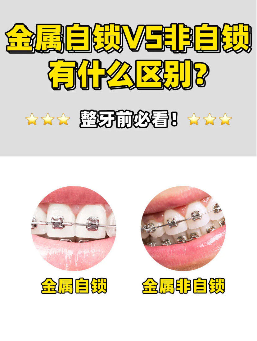 暑期正畸黄金期丨金属自锁矫正vs非自锁