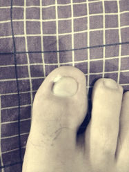 iphone_upload_pic-EPAI·灰指甲·甲沟炎·嵌甲护理