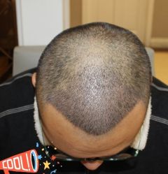 -大麦微针植发丨全国连锁