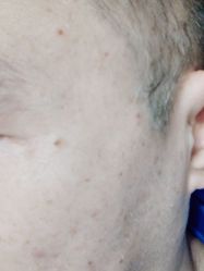 -痣清宫祛斑祛痣连锁店