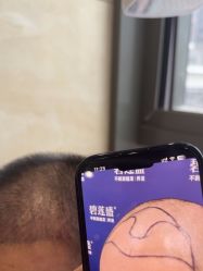 -碧莲盛·不剃发植发