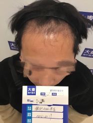 点击看大图 -大麦微针植发丨全国连锁