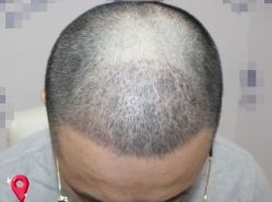 -大麦微针植发丨全国连锁