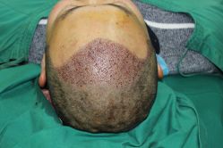 -大麦微针植发丨全国连锁