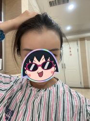 -碧莲盛·不剃发植发