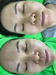 -清颜堂专业祛痘