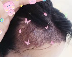 -大麦微针植发全国连锁