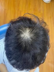 -大麦微针植发全国连锁