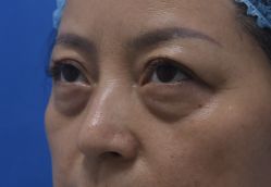 -天津健丽·去眼袋医疗美容机构