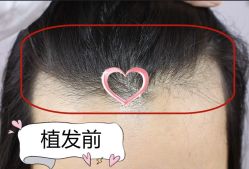 -大麦微针植发丨全国连锁