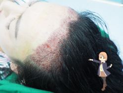 -大麦微针植发丨全国连锁