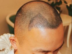 -大麦微针植发全国连锁