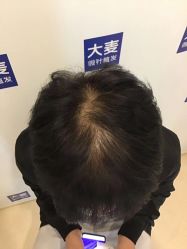 点击看大图 -大麦微针植发丨全国连锁